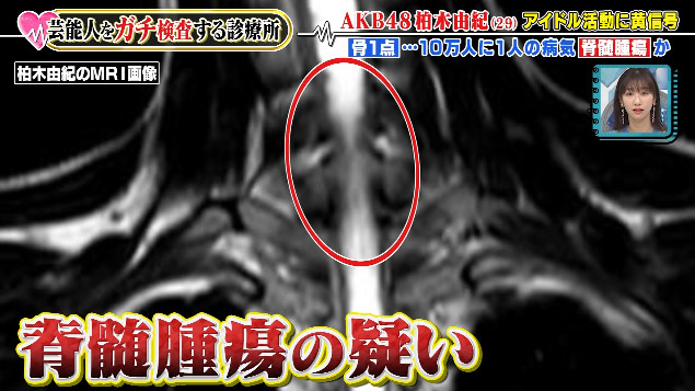 E3AFdbYVEAQ6ZHa - Kashiwagi Yuki Umumkan Hiatus dari AKB48 dan Dunia Entertainment Akibat Penyakitnya. Diagnosa Dokter Tentang Penyakit yang di Derita Kashiwagi Yuki