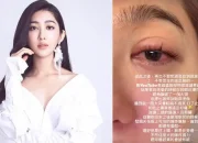 Serena Wang Suffers Eye Injury After Microwave Egg Explosion