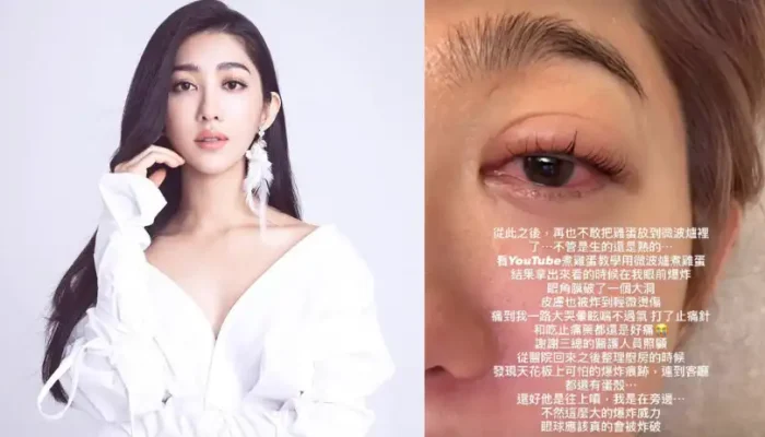 Serena Wang Suffers Eye Injury After Microwave Egg Explosion